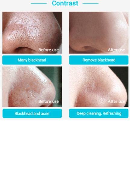 Comparison of nose skin before and after using Advanced Blackhead Remover & Nasal Membrane Kit, highlighting blackhead and acne removal.