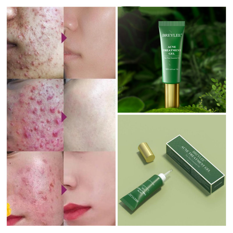 🌿 Acne Scar Removal Gel – Heal, Brighten & Restore