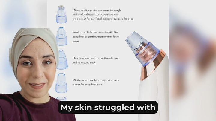 Electric Blackhead Remover – Deep Cleanse & Clear Skin Confidence